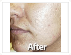 facial Acne Scars Treatment after
