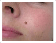 skin tags on face before