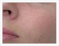 skin tags on face after