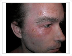 face eczema treatment before