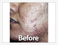 facial Acne Scars Treatment before