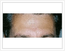 botox and fillers before