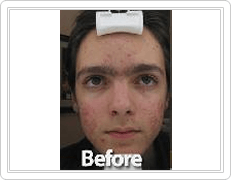Acne Scar Treatment before