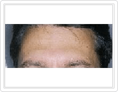 botox and fillers after