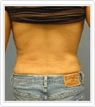 abdomen liposuction after