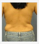 abdomen liposuction before