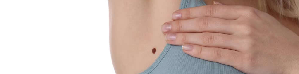 how to remove skin tags