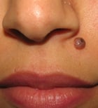 facial mole removal before