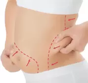Liposuction in lahore
