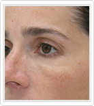 Mesotherapy Treatment after