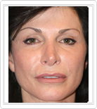 Mesotherapy result after