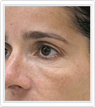 Mesotherapy Treatment before