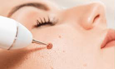 mole removal in lahore