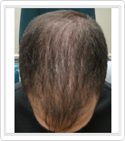 prp hair treatment after