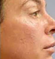 prp skin treatment after