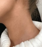 skin mole removal after