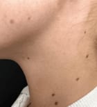 skin mole removal before