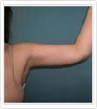 Upper Arms Liposuction after
