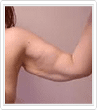 Upper Arms Liposuction before